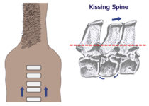 Kissing Spine