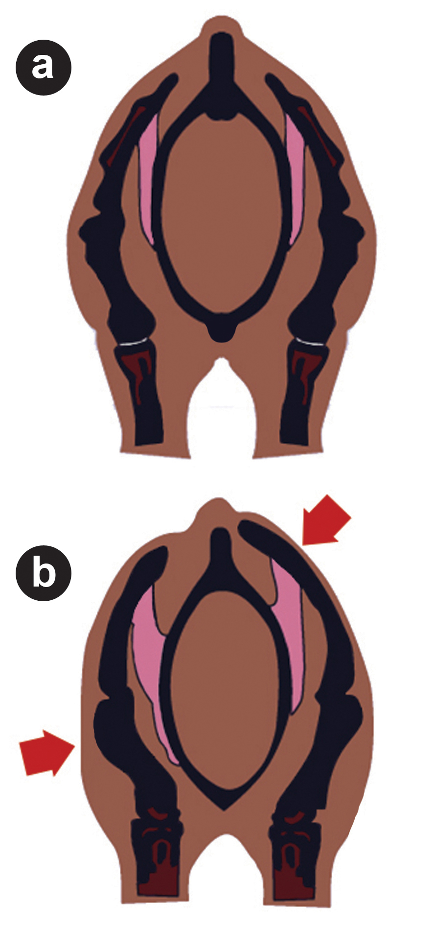 The cross sections above shows: (a) an even skeletal structure; (b) a distinctly higher, left shoulder blade, with a stronger humerus on the right.